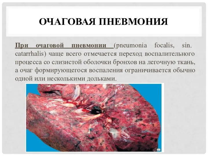 ОЧАГОВАЯ ПНЕВМОНИЯ При очаговой пневмонии (pneumonia focalis, sin. catarrhalis) чаще всего