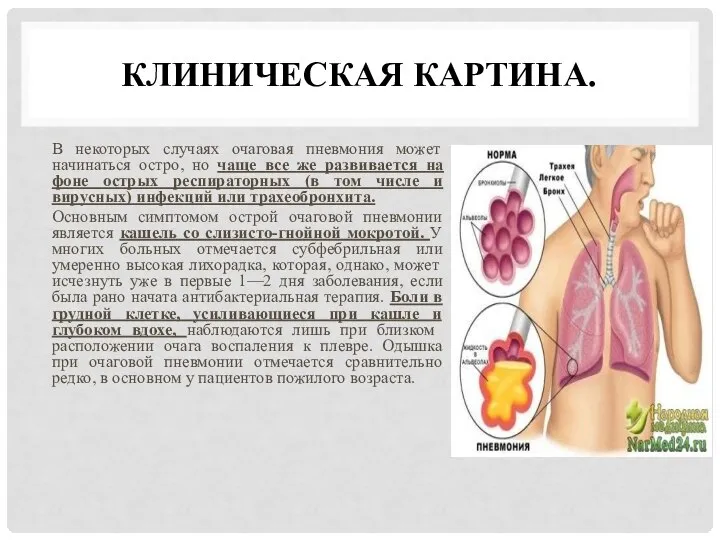 КЛИНИЧЕСКАЯ КАРТИНА. В некоторых случаях очаговая пневмония может начинаться остро, но