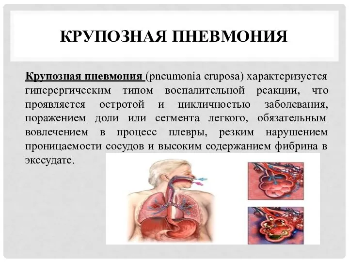 КРУПОЗНАЯ ПНЕВМОНИЯ Крупозная пневмония (pneumonia cruposa) характеризуется гиперергическим типом воспалительной реакции,