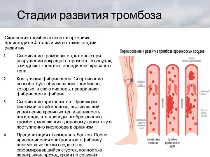 Стадии развития тромбоза Скопление тромбов в венах и артериях происходит в