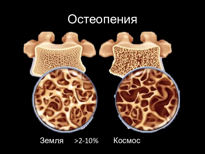 Остеопения Земля >2-10% Космос