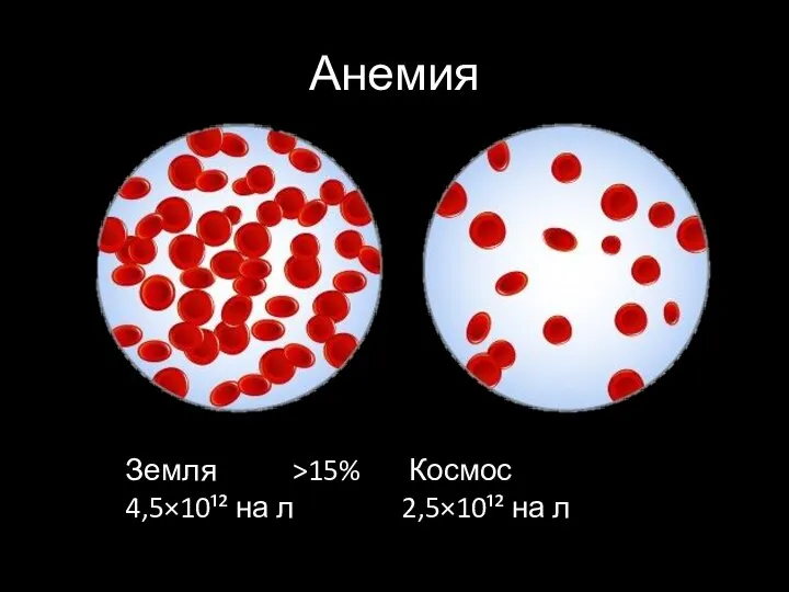 Анемия Земля >15% Космос 4,5×10¹² на л 2,5×10¹² на л