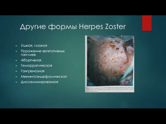 Другие формы Herpes Zoster Ушная, глазная Поражение вегетативных ганглиев Абортивная Геморрагическая Гангренозная Менингоэнцефалическая Диссеминированная