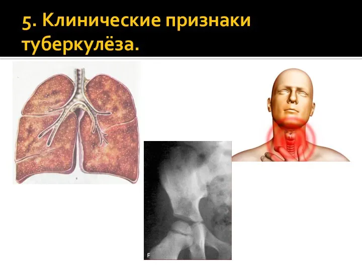 5. Клинические признаки туберкулёза.
