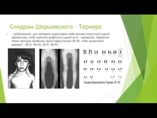 Синдром Шершевского – Тернера - заболевание, для которого характерно либо полное