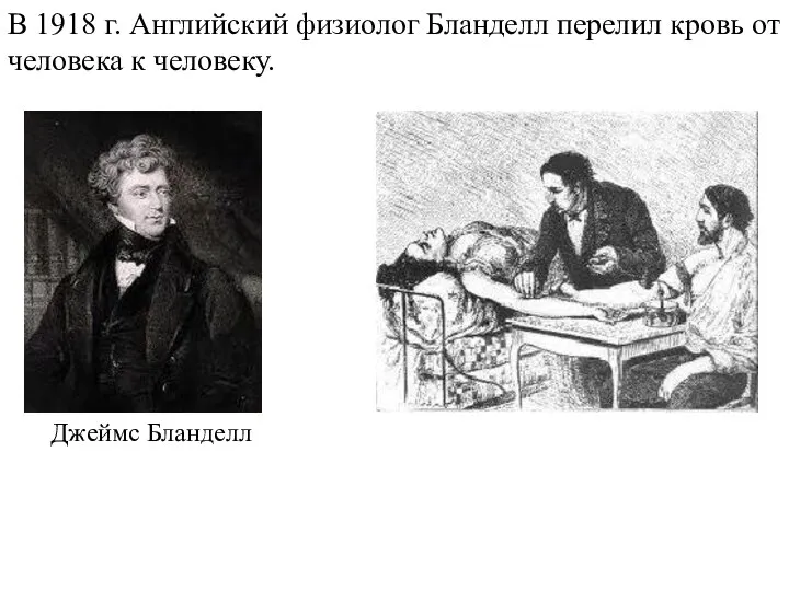 В 1918 г. Английский физиолог Бланделл перелил кровь от человека к человеку. Джеймс Бланделл