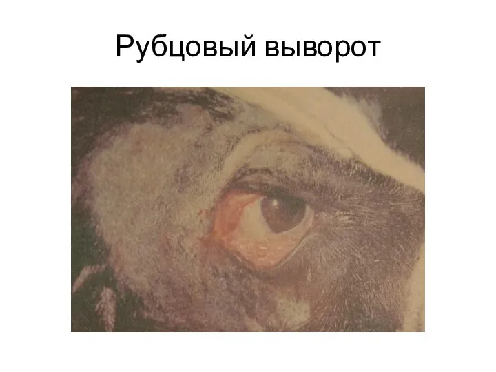 Рубцовый выворот