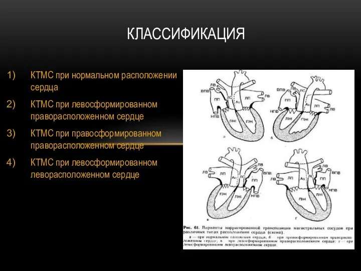 КТМС при нормальном расположении сердца КТМС при левосформированном праворасположенном сердце КТМС