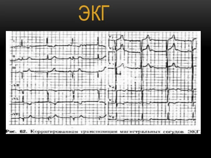 ЭКГ