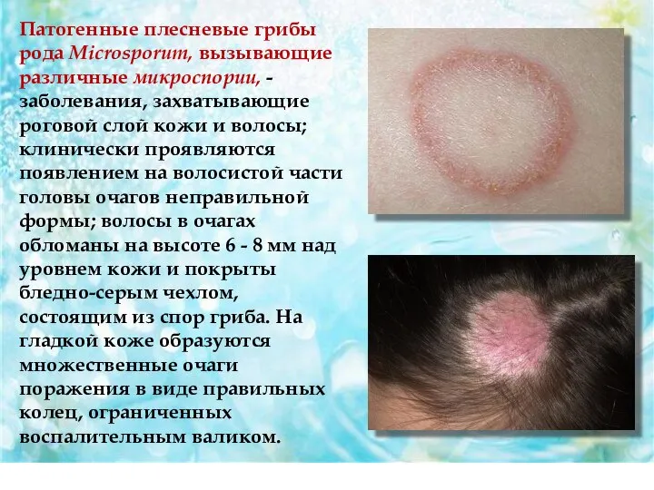 Патогенные плесневые грибы рода Microsporum, вызывающие различные микроспории, - заболевания, захватывающие