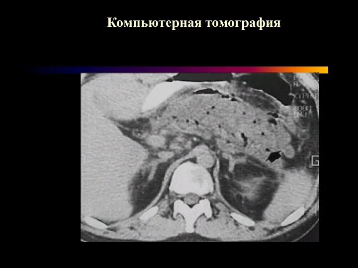 Компьютерная томография