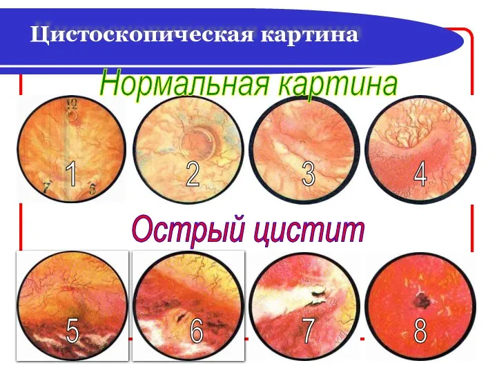 Цистоскопическая картина Нормальная картина Острый цистит 1 2 3 4 5 6 7 8