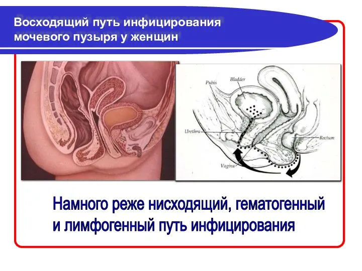 Восходящий путь инфицирования мочевого пузыря у женщин Намного реже нисходящий, гематогенный и лимфогенный путь инфицирования