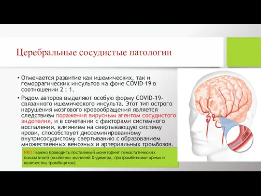 Церебральные сосудистые патологии Отмечается развитие как ишемических, так и геморрагических инсультов