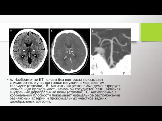 А. Изображение КТ головы без контраста показывает симметричные участки гипоаттенуации в