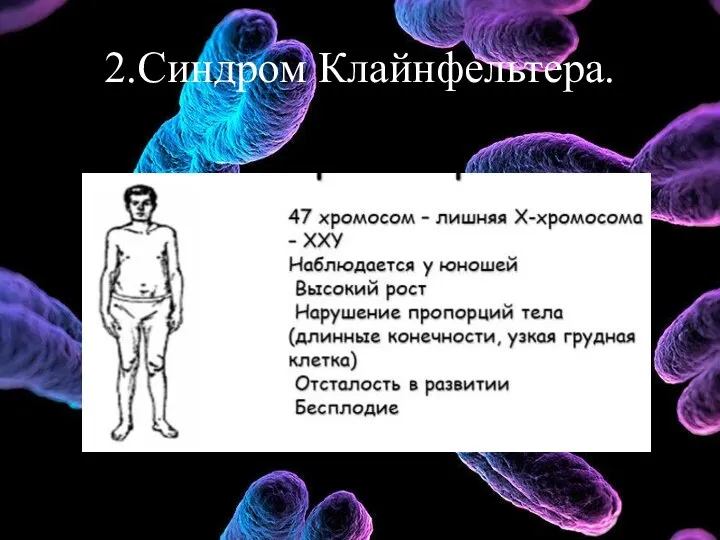 2.Синдром Клайнфельтера.