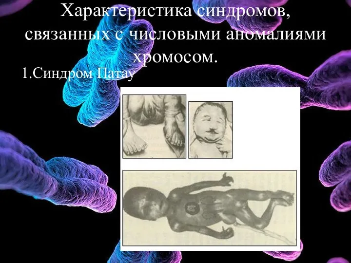 Характеристика синдромов, связанных с числовыми аномалиями хромосом. 1.Синдром Патау