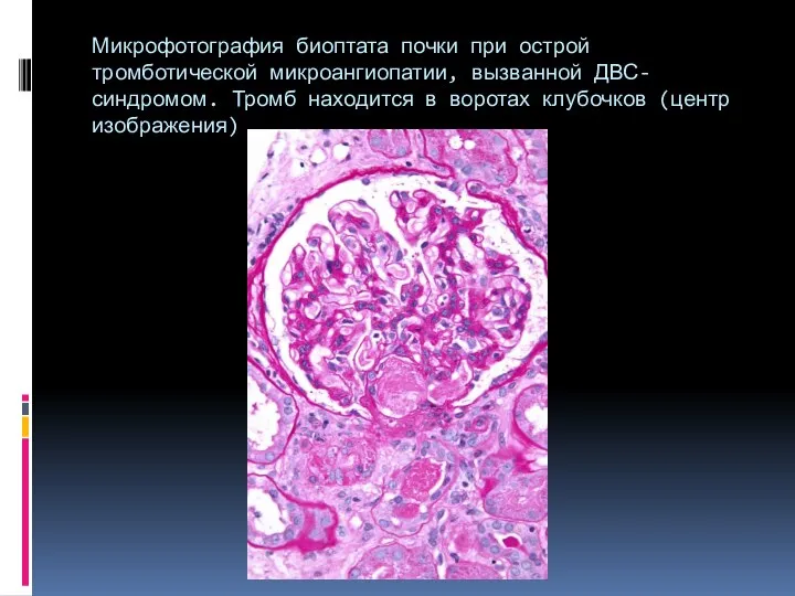 Микрофотография биоптата почки при острой тромботической микроангиопатии, вызванной ДВС-синдромом. Тромб находится в воротах клубочков (центр изображения)