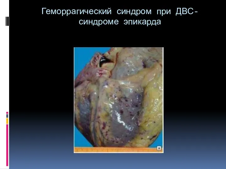 Геморрагический синдром при ДВС-синдроме эпикарда