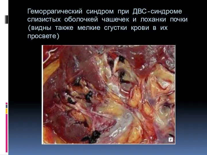 Геморрагический синдром при ДВС-синдроме слизистых оболочкей чашечек и лоханки почки (видны