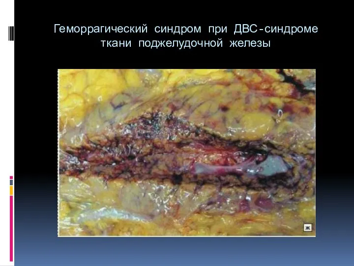 Геморрагический синдром при ДВС-синдроме ткани поджелудочной железы