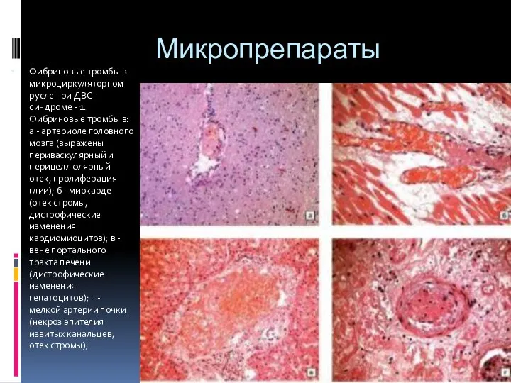 Микропрепараты Фибриновые тромбы в микроциркуляторном русле при ДВС-синдроме - 1. Фибриновые