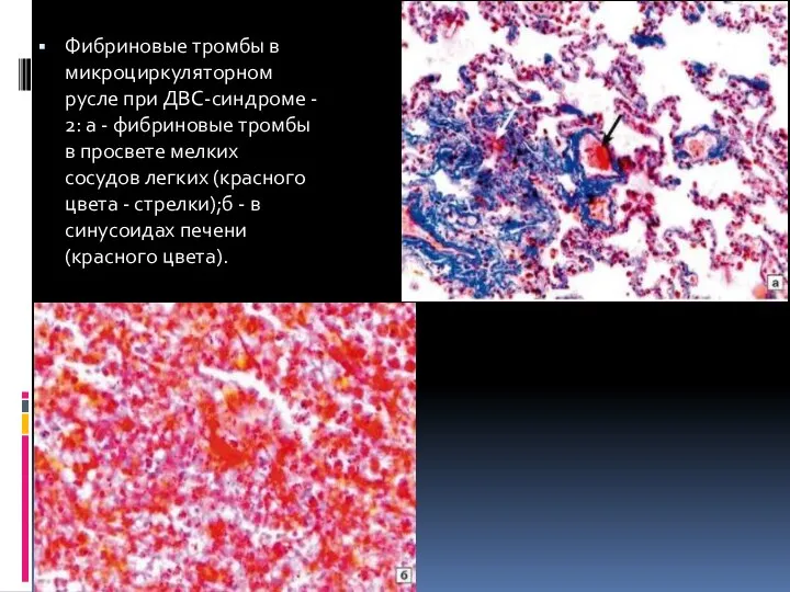 Фибриновые тромбы в микроциркуляторном русле при ДВС-синдроме - 2: а -