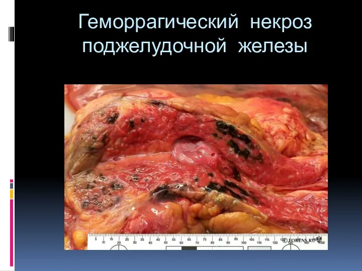 Геморрагический некроз поджелудочной железы