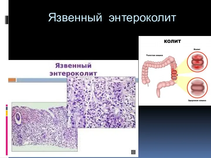 Язвенный энтероколит