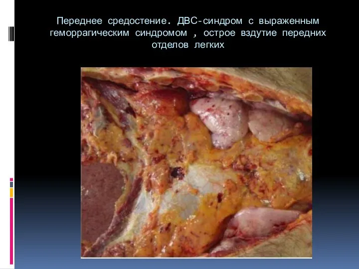 Переднее средостение. ДВС-синдром с выраженным геморрагическим синдромом , острое вздутие передних отделов легких