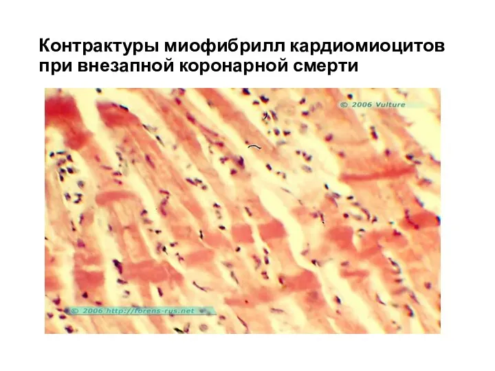 Контрактуры миофибрилл кардиомиоцитов при внезапной коронарной смерти