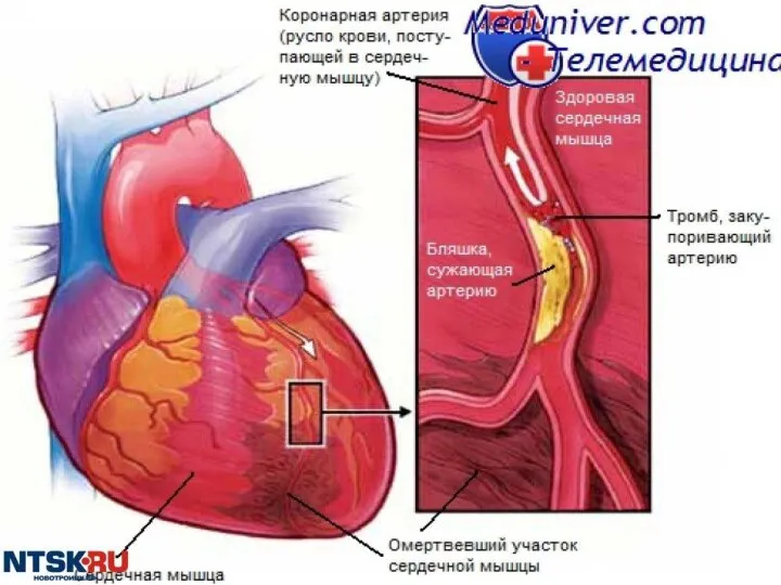 ИНФАРКТ МИОКАРДА