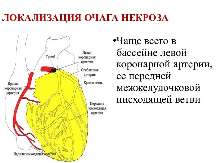 ЛОКАЛИЗАЦИЯ ОЧАГА НЕКРОЗА Чаще всего в бассейне левой коронарной артерии, ее передней межжелудочковой нисходящей ветви