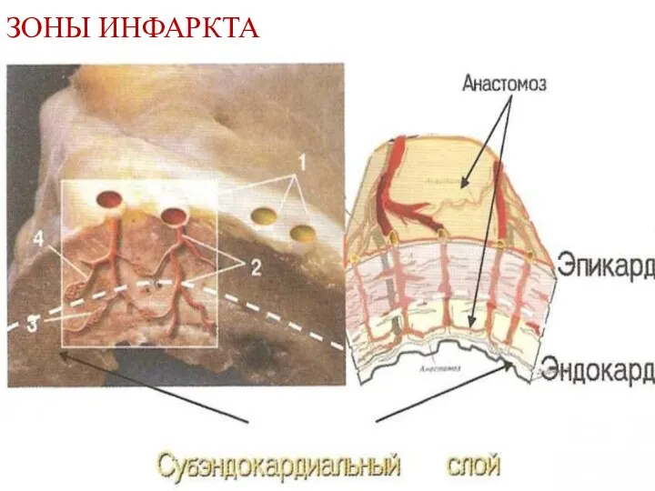 ЗОНЫ ИНФАРКТА