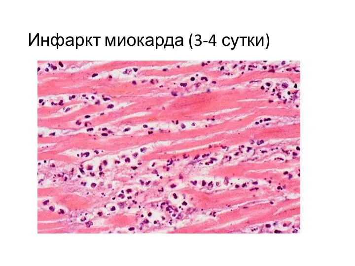 Инфаркт миокарда (3-4 сутки)