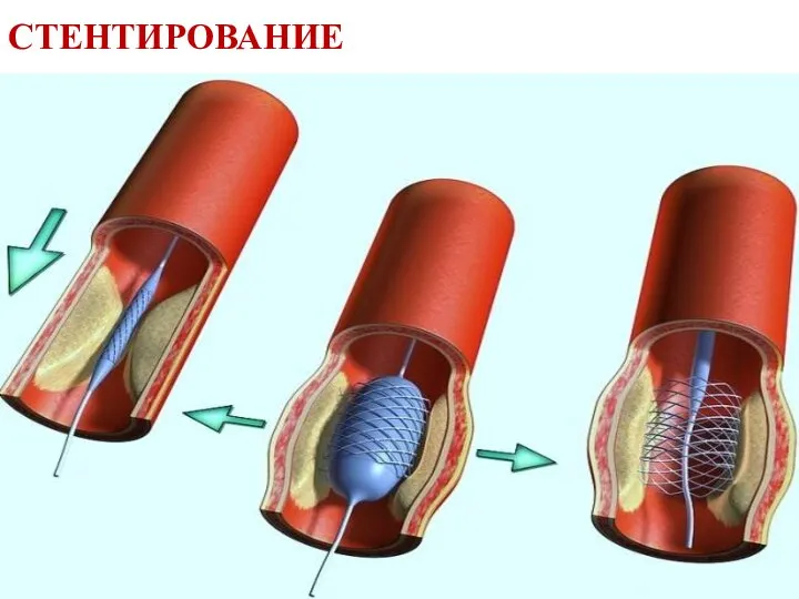 СТЕНТИРОВАНИЕ