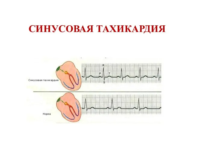 СИНУСОВАЯ ТАХИКАРДИЯ