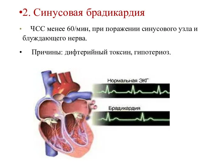 2. Синусовая брадикардия ЧСС менее 60/мин, при поражении синусового узла и