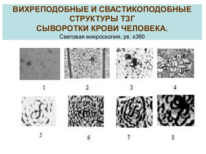 ВИХРЕПОДОБНЫЕ И СВАСТИКОПОДОБНЫЕ СТРУКТУРЫ ТЗГ СЫВОРОТКИ КРОВИ ЧЕЛОВЕКА. Световая микроскопия, ув. х360