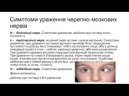 Симптоми ураження черепно-мозкових нервів ІV – блоковий нерв. Симптоми ураження: двоїння