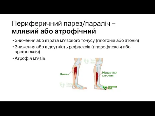 Периферичний парез/параліч – млявий або атрофічний Зниження або втрата м’язового тонусу