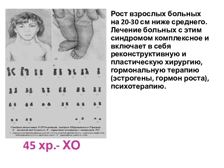 45 хр.- ХО Рост взрослых больных на 20-30 см ниже среднего.