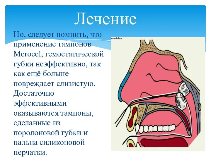 Но, следует помнить, что применение тампонов Merocel, гемостатической губки неэффективно, так