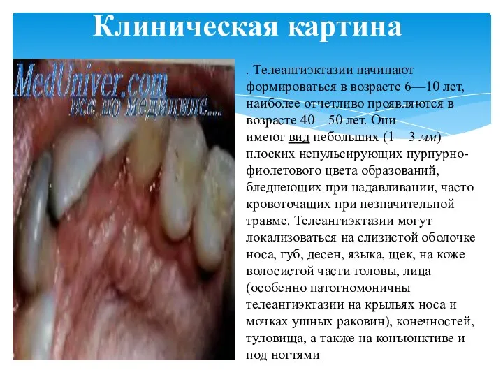 . Телеангиэктазии начинают формироваться в возрасте 6—10 лет, наиболее отчетливо проявляются