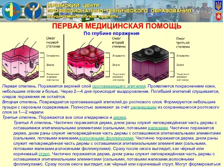 ПЕРВАЯ МЕДИЦИНСКАЯ ПОМОЩЬ По глубине поражения Первая степень. Поражается верхний слой