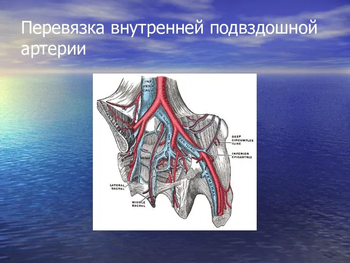 Перевязка внутренней подвздошной артерии