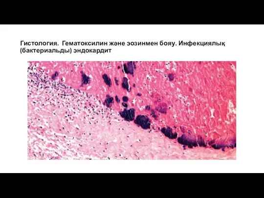 Гистология. Гематоксилин және эозинмен бояу. Инфекциялық (бактериальды) эндокардит