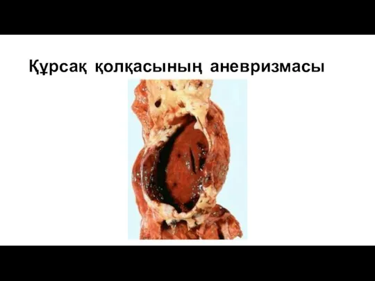 Құрсақ қолқасының аневризмасы