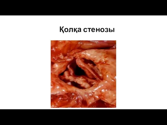 Қолқа стенозы