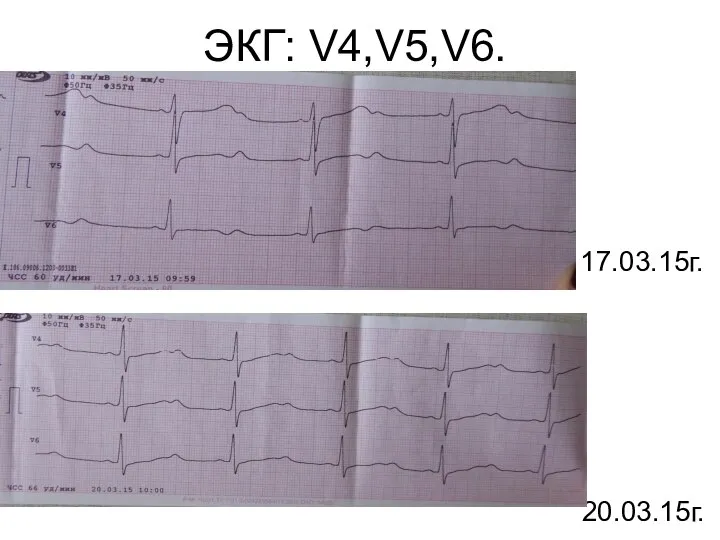 ЭКГ: V4,V5,V6. 17.03.15г. 20.03.15г.